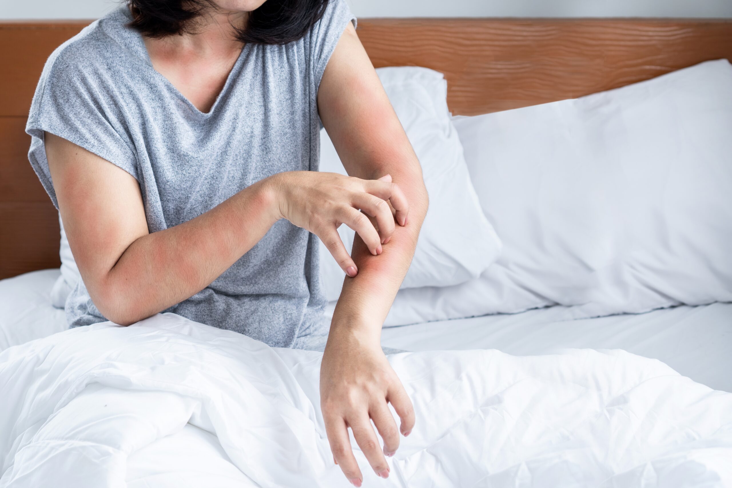 How to Tell Bed Bug Bites From Flea Bites in Slidell