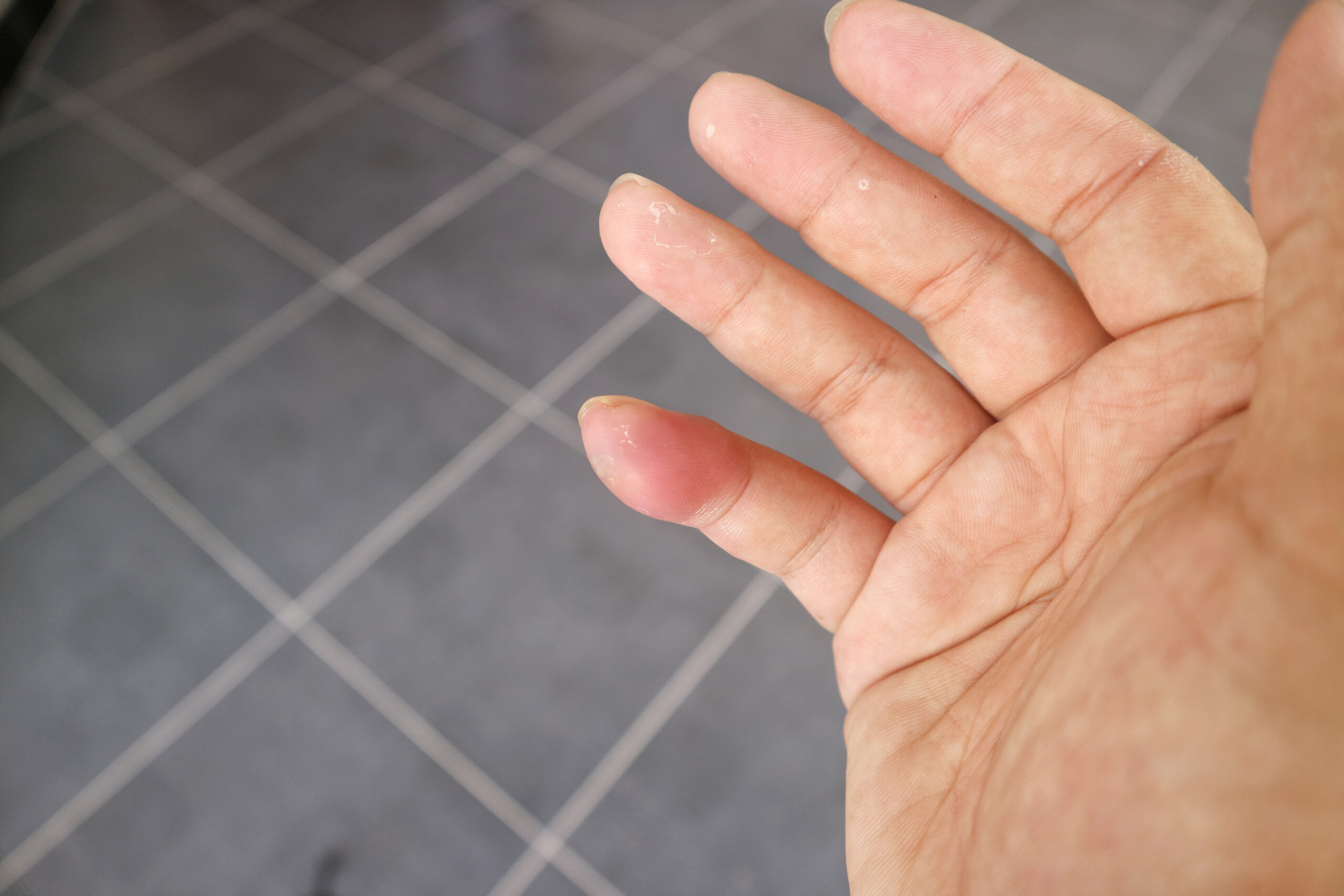 spider-bites-when-to-worry-baton-rouge