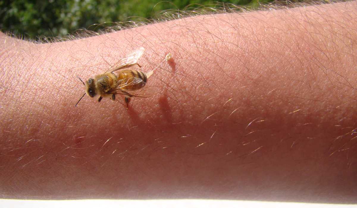 Most Painful Sting: Signs, Risks, and Control